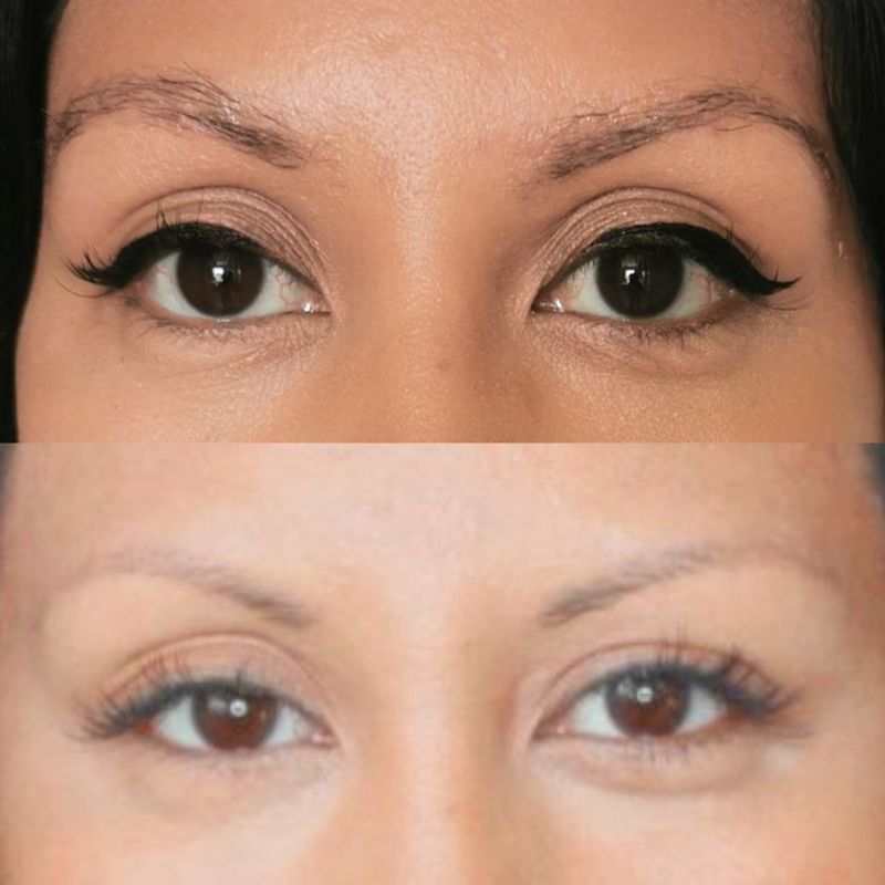 Eyebrow Transplants: The Permanent Fix