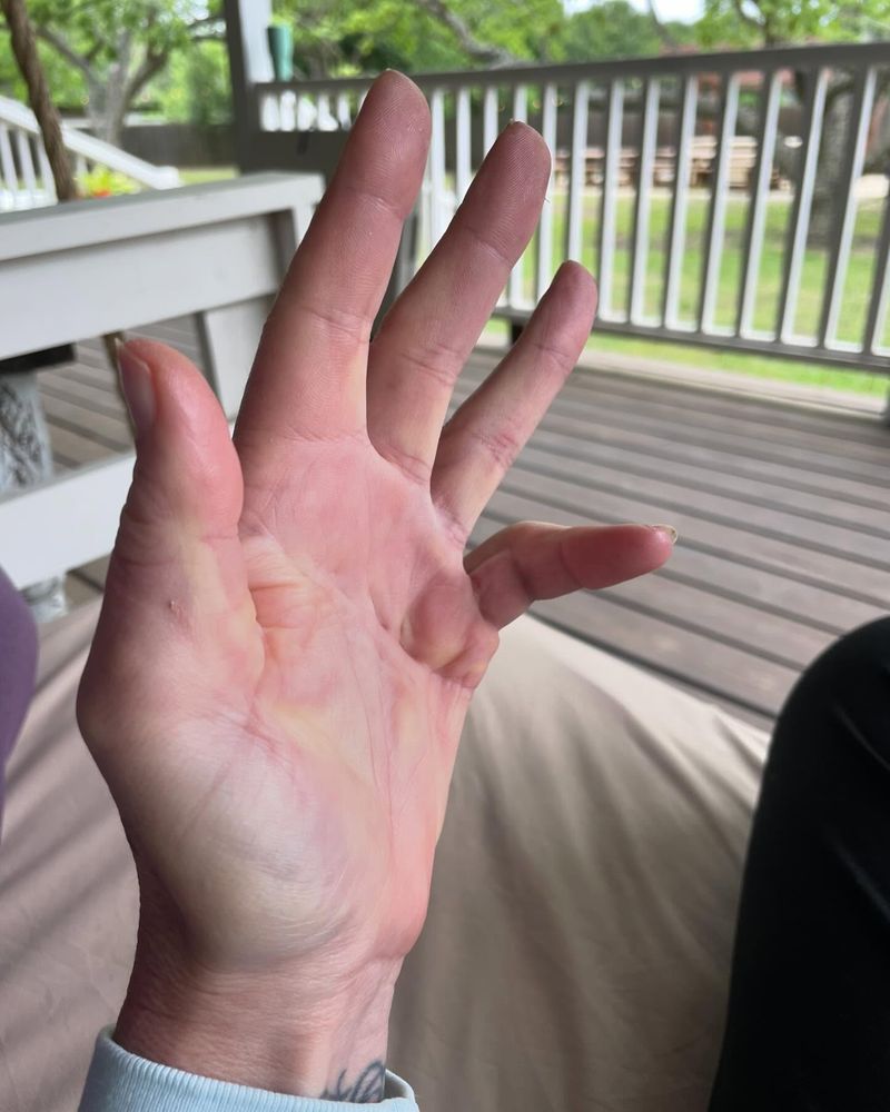 The Fidgety Hand Syndrome