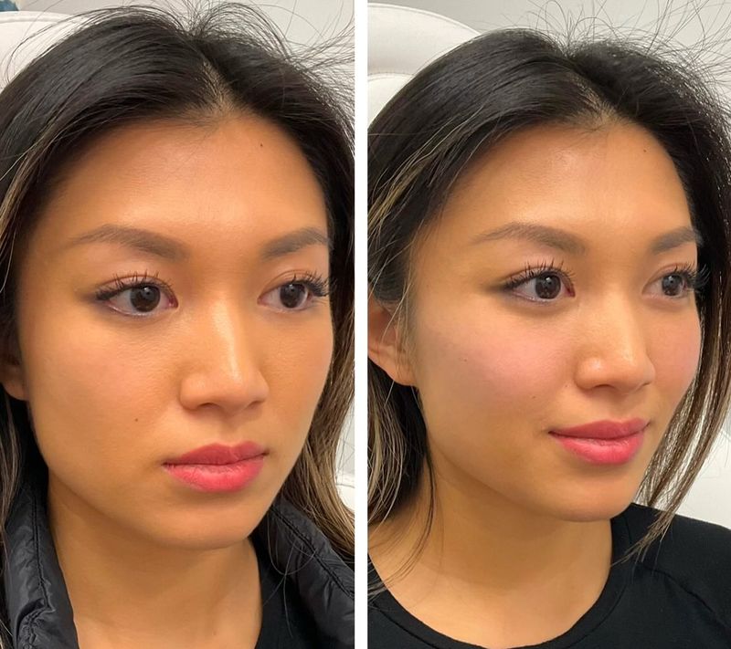 Hyaluronic Acid Fillers: Restoring Lost Volume