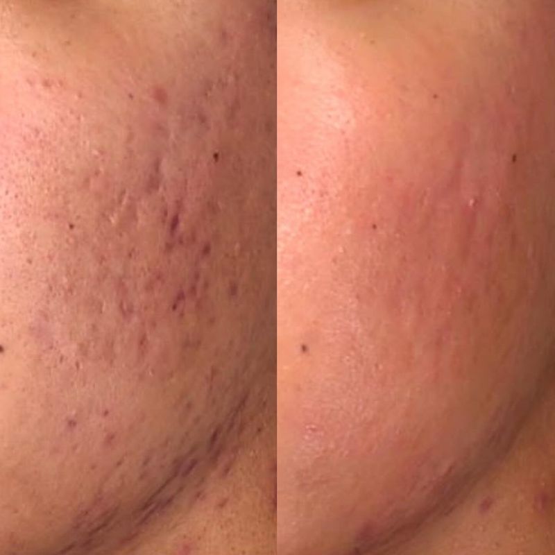 Laser Resurfacing: High-Tech Skin Renewal