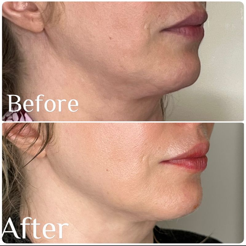 Radiofrequency Therapy: Heat That Tightens