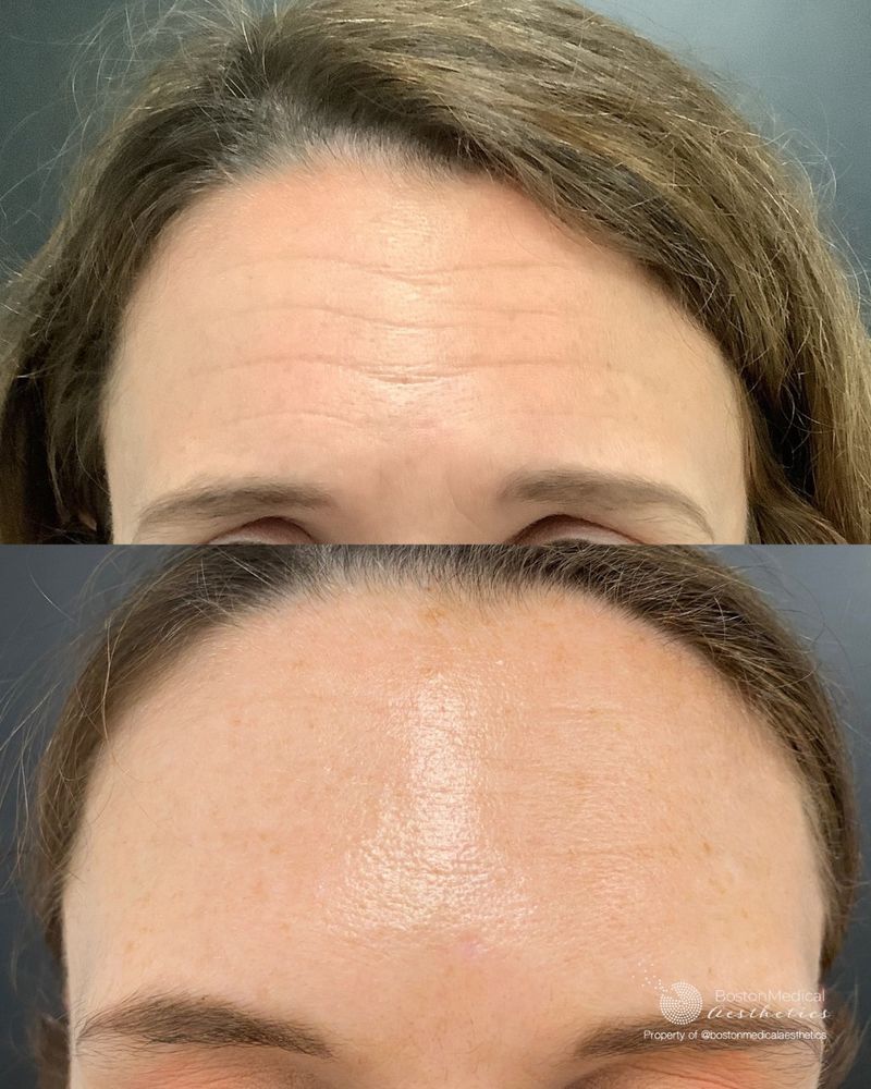 Botox: Freezing Time Temporarily