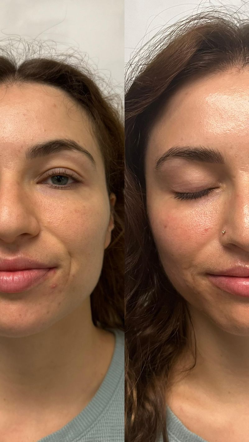 Ultherapy: Ultrasound Lifting