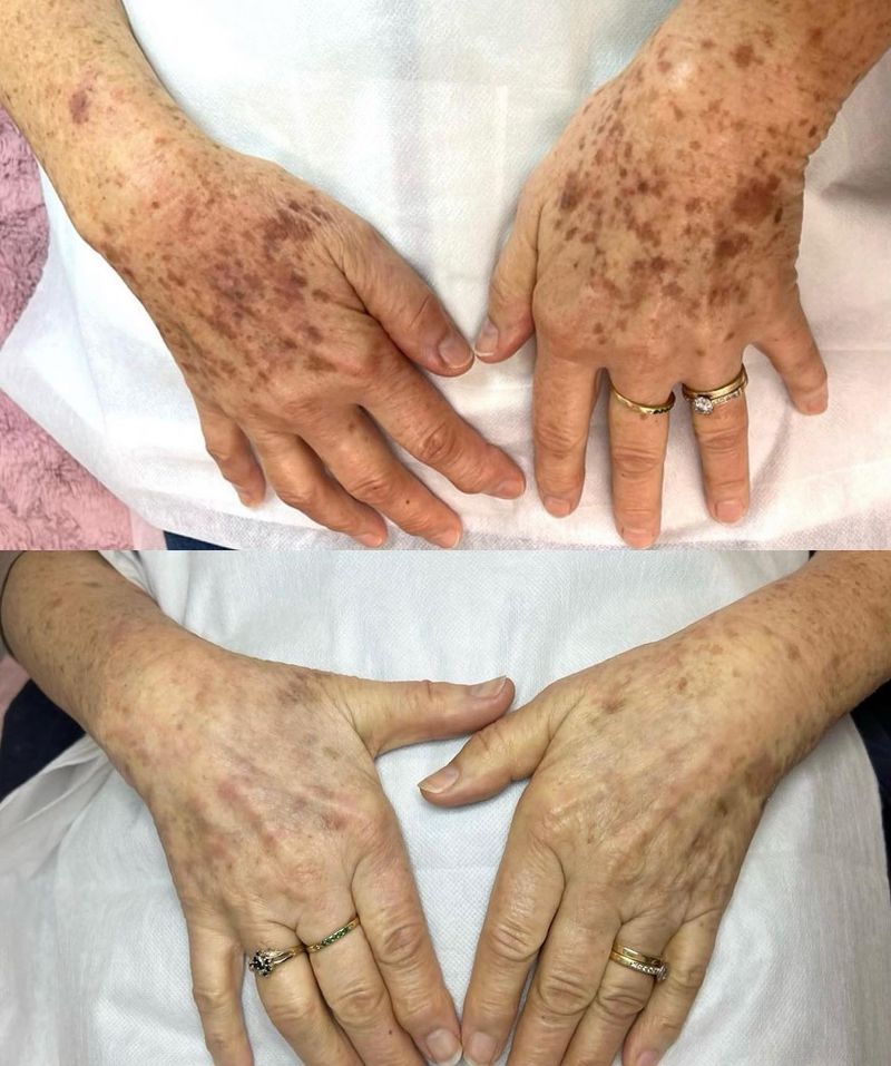 Age Spots Making Their Mark